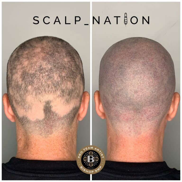 forms of alopecia
