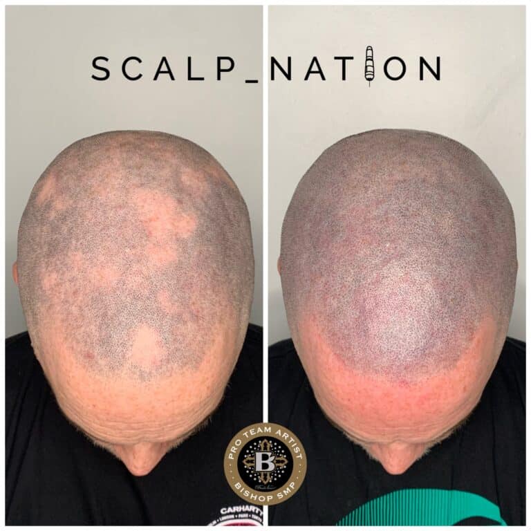 forms of alopecia