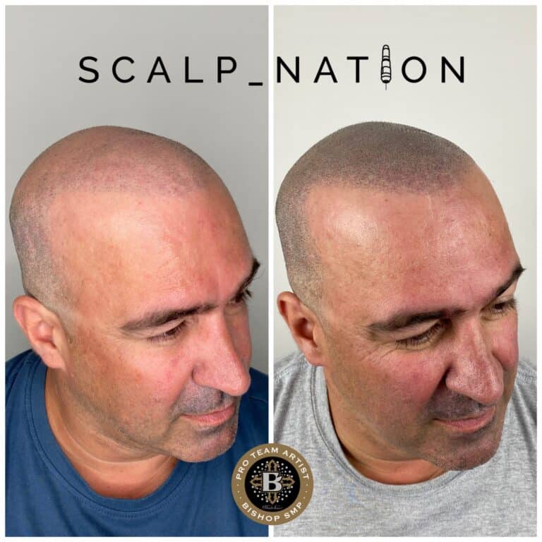 scalp-micropigmentation-for-scarring-after