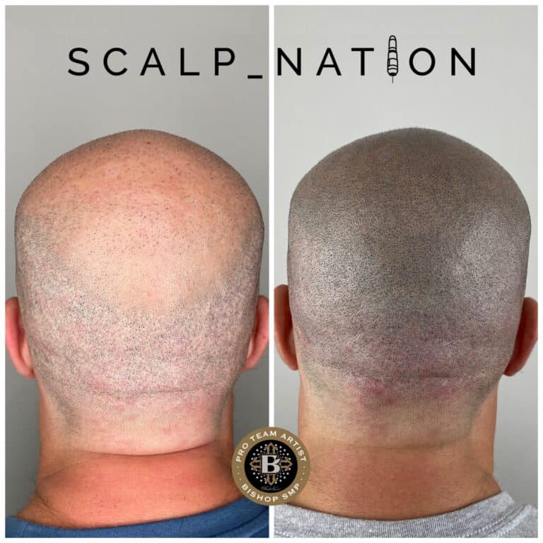 scalp-micropigmentation-for-scarring-before-and-after