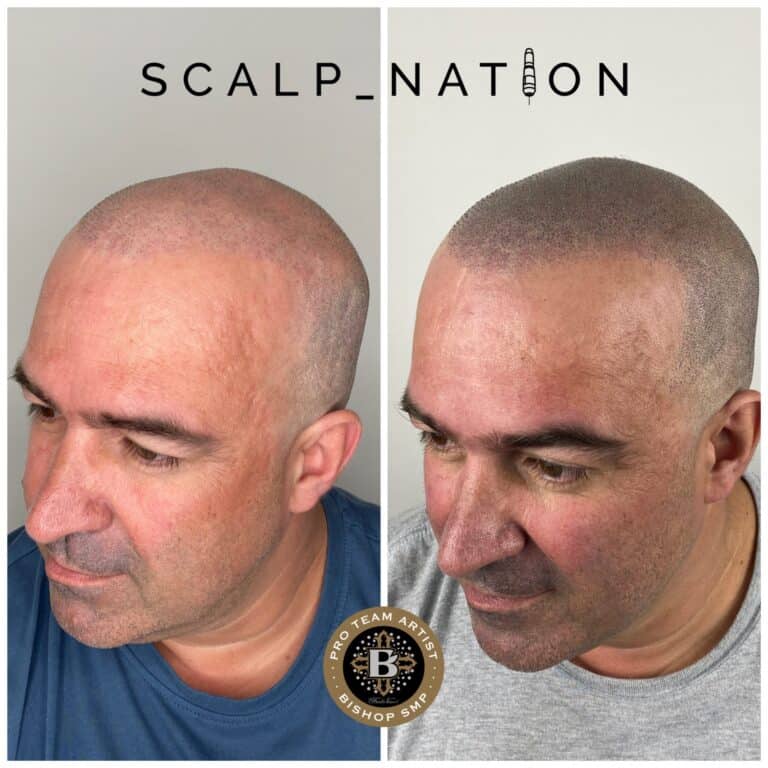scalp-micropigmentation-for-scarring-before