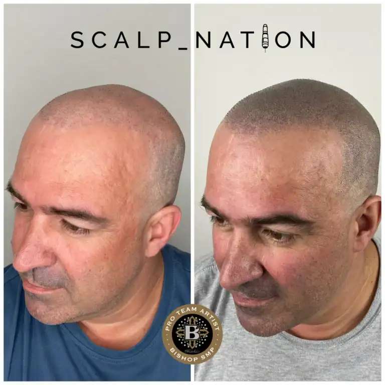 ADS-smp-after-hair-transplant-1