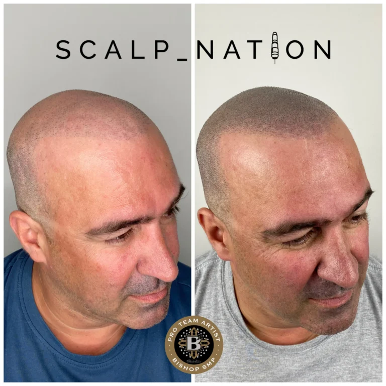 ADS-smp-after-hair-transplant-2