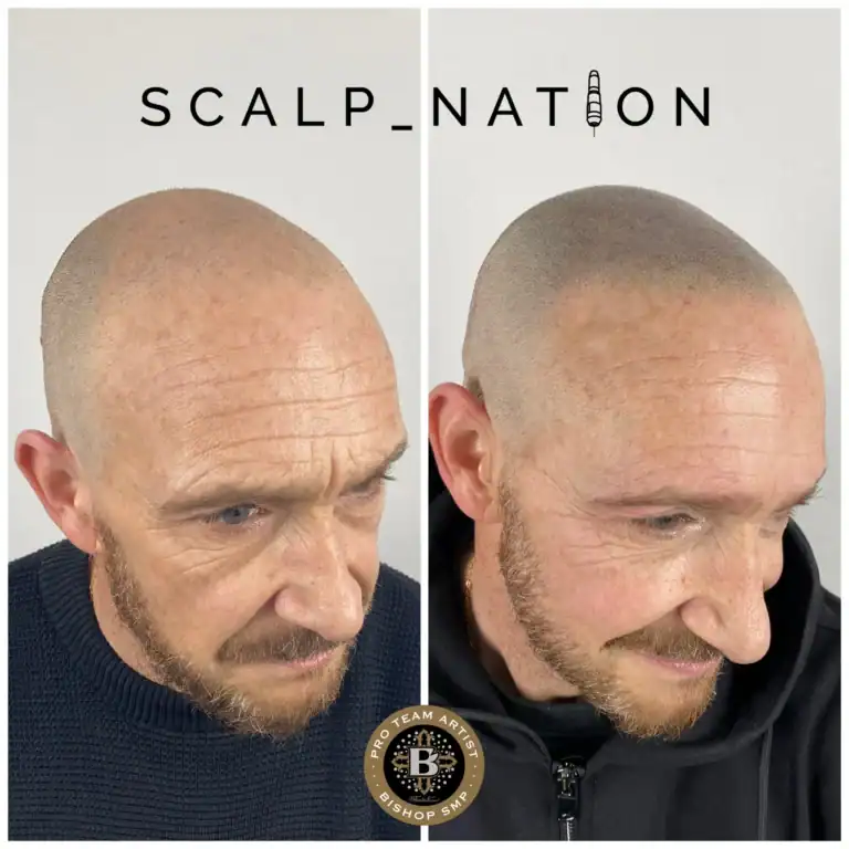 SH-smp-after-hair-transplant-2