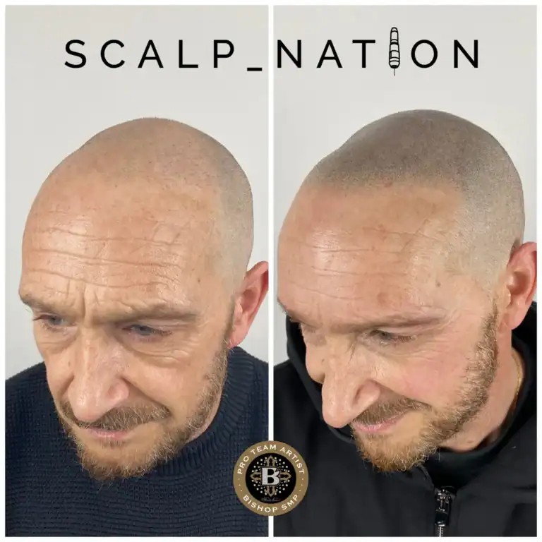 SH-smp-after-hair-transplant-3