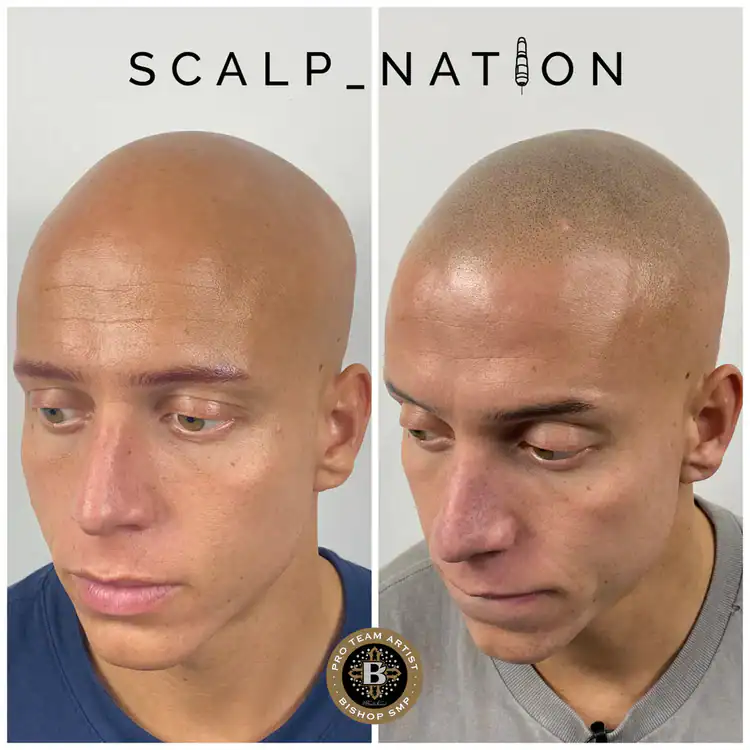 alopecia-SMP-TM