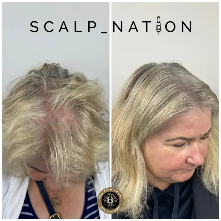 female-density-scalp-micropigmentation-KM2
