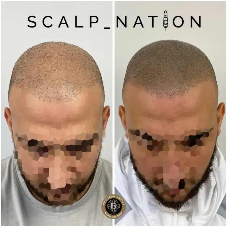 scalp-micropigmentation-after-hair-transplant