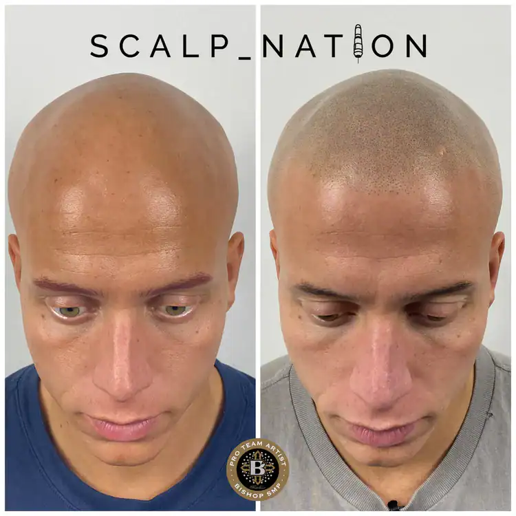 scalp-micropigmentation-for-alopecia-TM