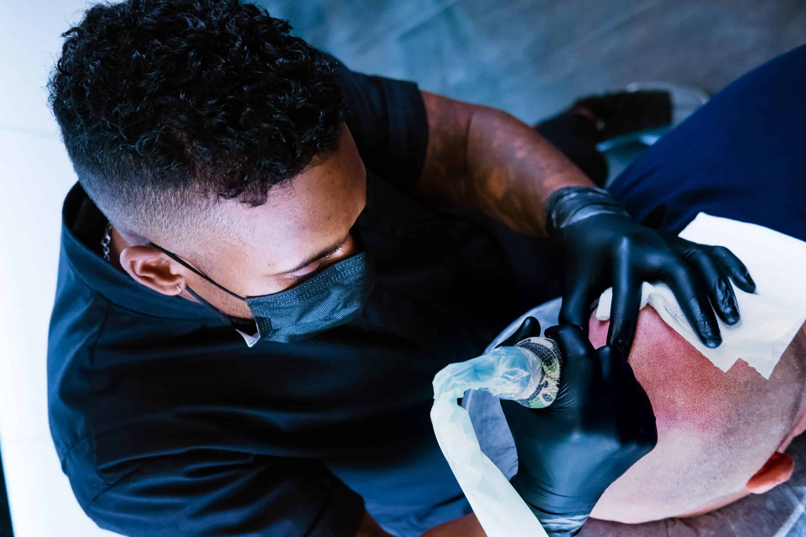 hair transplant
