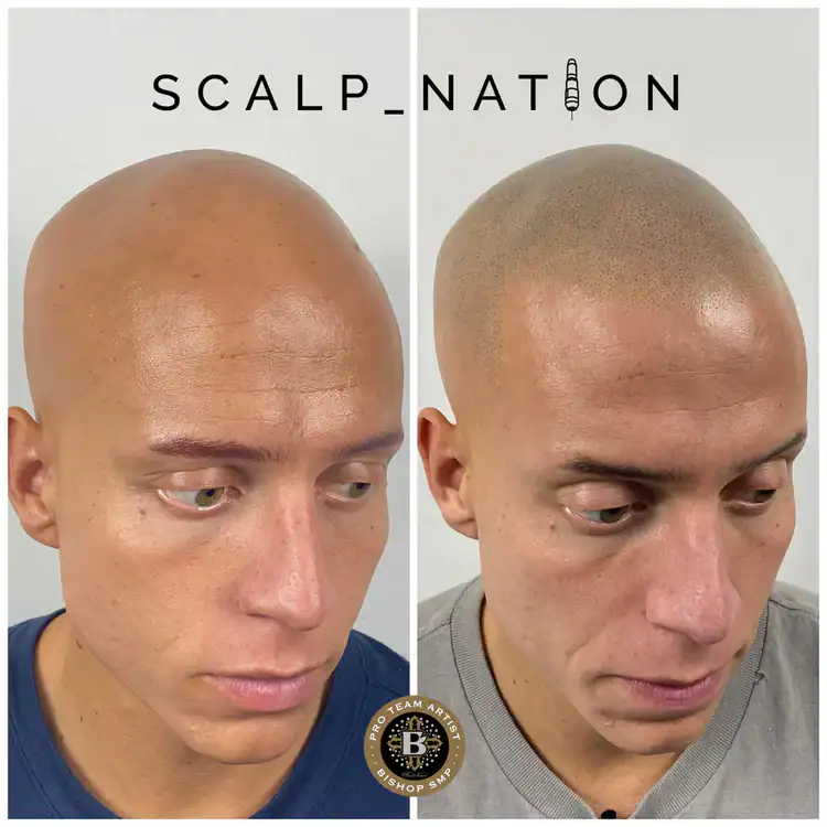 alopecia head tattoo