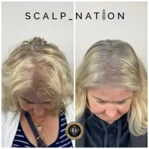 Home 26 female density scalp micropigmentation KM1 1024x1024 1