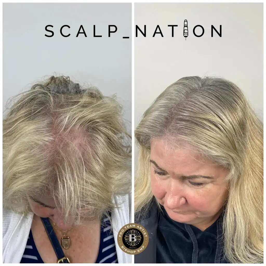 female density scalp micropigmentation KM3 1024x1024 1