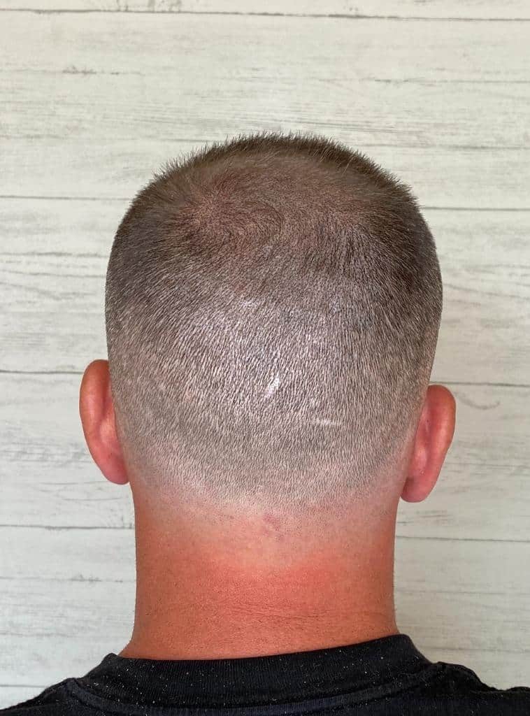 scalp micropigmentation for long hair