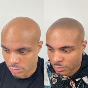 COSTS 3 Alopecia 1