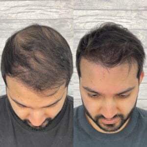 COSTS 5 hair density 1