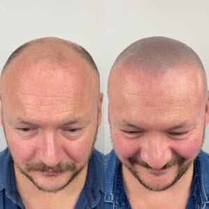 COSTS 2 top of head 1